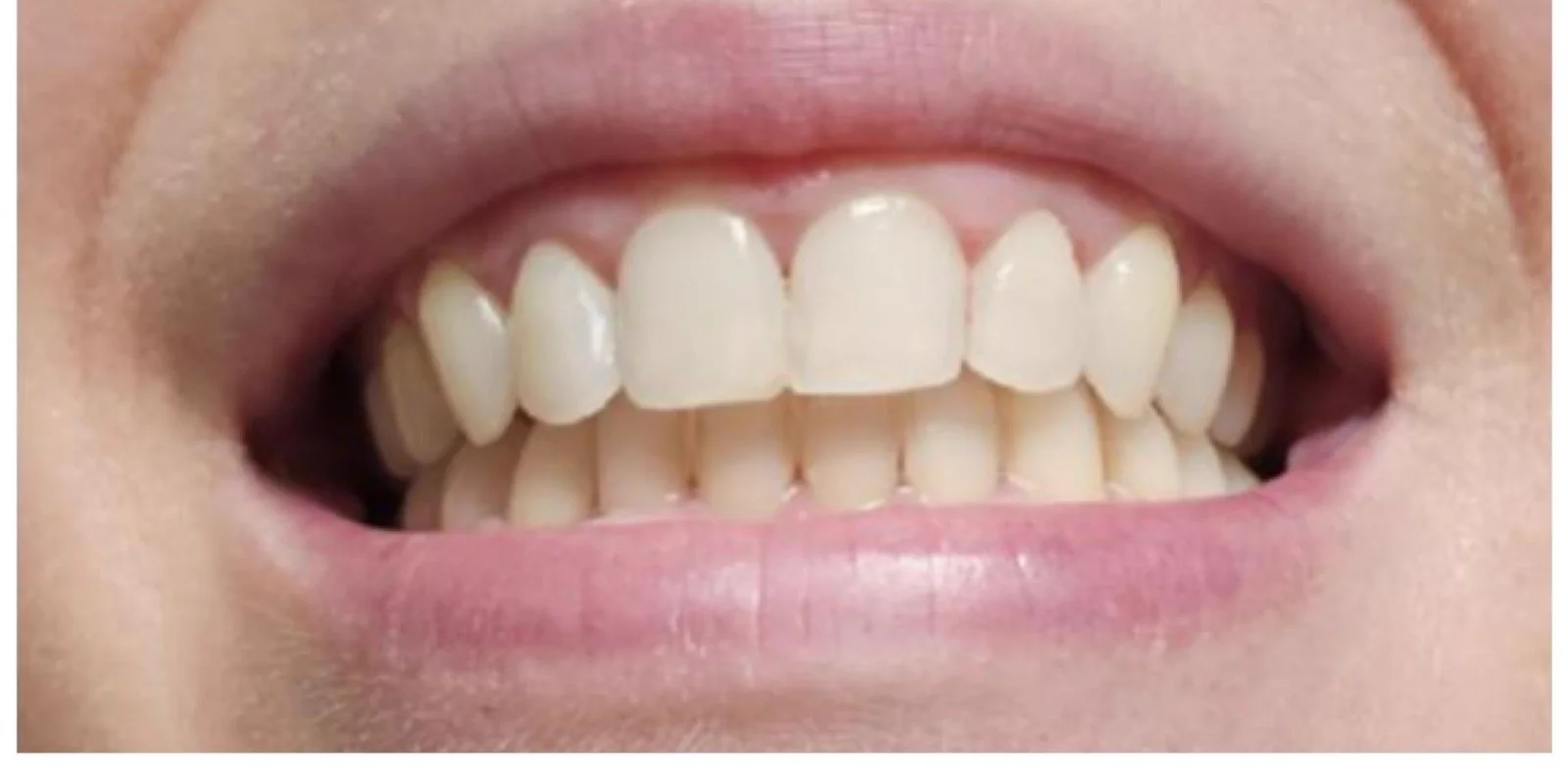Sorriso após branqueamento dentário