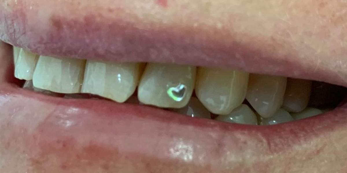 Piercing dentário em forma de coração colado a um dente