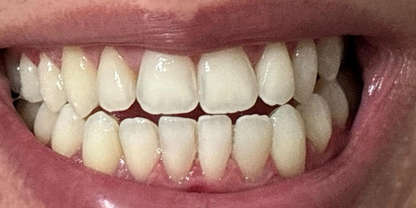 Branqueamento dentário — depois do tratamento